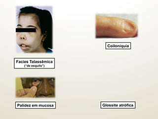 Coiloníquia
Facies Talassêmica
(“de esquilo”)
Glossite atróficaPalidez em mucosa
 