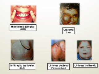 Hiperplasia gengival
(LMA) Cloroma
(LMA)
Infiltração testicular
(LLA)
Linfoma cutâneo
(Forma nodular)
Linfoma de Burkitt
 