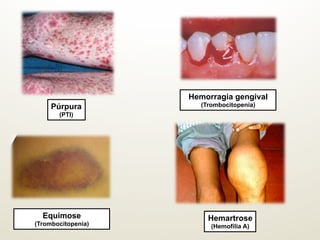 Púrpura
(PTI)
Hemorragia gengival
(Trombocitopenia)
Equimose
(Trombocitopenia)
Hemartrose
(Hemofilia A)
 