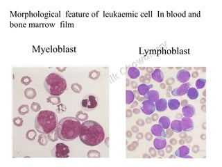 Myeloblast Lymphoblast
Morphological feature of leukaemic cell In blood and
bone marrow film
 