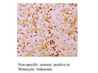 Non-specific esterase positive in
Monocytic leukaemia
 