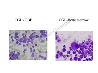 CGL - PBF CGL-Bone marrow
 
