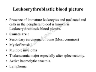 Leukemia,mds,myeloproliferative