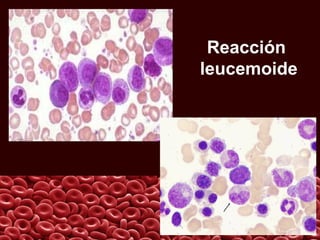 Reacción
leucemoide
 