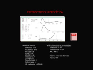 ERITROCITOSIS MICROCÍTICA

Diferencial manual
Linfocitos: 55%
Neutrófilos: 36%
Monocitos: 5
Bandas: 1%
Basófilos: 3%
Anisocitosis: +
Poiquilocitosis: +
Policromasia: +
GR nucleados: 1/1000GR

(CD) Diferencial automatizado
Linfocitos: 45.9%
Granulocitos: 49.5%
MID: 4.6 %
Valores serie roja alterados
Alarma URI

 