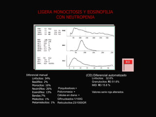 LIGERA MONOCITOSIS Y EOSINOFILIA
CON NEUTROPENIA

Diferencial manual
Linfocitos: 34%
Basófilos: 2%
Monocitos: 16%
Neutrófilos: 26%
Eosinófilos: 13%
Bandas:7%
Mielocitos: 1%
Metamielocitos: 1%

(CD) Diferencial automatizado
Linfocitos: 32.6%
Granulocitos: R3 51.6%
MID: R3 15.8 %
Poiquilositosis:+
Policromasia: +
Células en diana: +
GRnucleados:1/100G
Reticulocitos:23/1000GR

Valores serie roja alterados

 