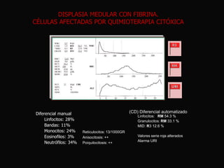 DISPLASIA MEDULAR CON FIBRINA.
CÉLULAS AFECTADAS POR QUIMIOTERAPIA CITÓXICA

Diferencial manual
Linfocitos: 28%
Bandas: 11%
Monocitos: 24%
Eosinofilos: 3%
Neutrófilos: 34%

(CD) Diferencial automatizado
Linfocitos: RM 54.3 %
Granulocitos: RM 33.1 %
MID: R3 12.6 %
Reticulocitos: 13/1000GR
Anisocitosis: ++
Poiquilocitosis: ++

Valores serie roja alterados
Alarma URI

 
