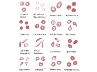 Eritrocito      Microcíticos              Macrociticos      Normoblastos
normal          Hipocrómicos




Esferocitos     Estomatocitos             Células diana     Dacriocitos




Eliptocitos     Célula                    Acantocitos       Equinocitos
(Ovalocitos)    falciforme




                               Prieto / Balcells
Esquistocitos     Bite cells              Howell-Jolly    Punteado basófilo
 