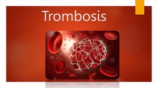 Trombosis
 