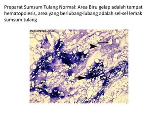 Preparat Sumsum Tulang Normal: Area Biru gelap adalah tempat
hematopoiesis, area yang berlubang-lubang adalah sel-sel lemak
sumsum tulang
 