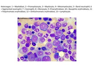 Keterangan: 1 = Myeloblast, 2 = Promyeloocyte, 3 = Myelocyte, 4 = Metamyelocytes, 5 = Band neutrophil, 6
= Segmented neutrophil, 7 = Eosinophil, 8 = Monocyte, 9 =Proerythroblast, 10 = Basophilic erythroblasts, 11
= Polychromatic erythroblast, 12 = Orthochromatic erythroblast, 13 = Lymphocyte.
 