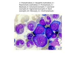 1 = Proerythroblast, 2 = Basophilic erythroblast, 3 =
Polychromatic erythroblast, 4 = Promyelocyte, 5 =
Myelocyte, 6 = Early band neutrophil, 7 =Late band
neutrophil, 8 = Segmented neutrophil, 9 = Band
eosinophil, 10 = Monocyte, 11 = Small lymphocyte.
 