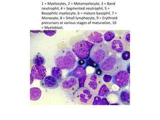 1 = Myelocytes, 2 = Metamyelocyte, 3 = Band
neutrophil, 4 = Segmented neutrophil, 5 =
Basophilic myelocyte, 6 = mature basophil, 7 =
Monocyte, 8 = Small lymphocyte, 9 = Erythroid
precursors at various stages of maturation, 10
= Myeloblast.
 