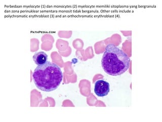 Perbedaan myelocyte (1) dan monocytes (2) myelocyte memiliki sitoplasma yang bergranula
dan zona perinuklear sementara monosit tidak berganula. Other cells include a
polychromatic erythroblast (3) and an orthochromatic erythroblast (4).
 