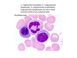 1 = Segmented neutrophil, 2 = Large granular
lymphocyte, 3 = polychromatic erythroblast.
Large granular lymphocytes are rare in bone
marrow (<0.5% of all nucleated cells).
 