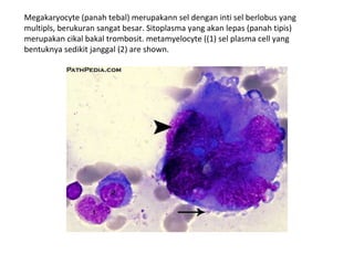 Megakaryocyte (panah tebal) merupakann sel dengan inti sel berlobus yang
multipls, berukuran sangat besar. Sitoplasma yang akan lepas (panah tipis)
merupakan cikal bakal trombosit. metamyelocyte ((1) sel plasma cell yang
bentuknya sedikit janggal (2) are shown.
 