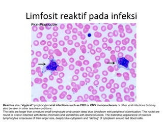 Limfosit reaktif pada infeksi
Reactive atau “atypical” lymphocytes viral infections such as EBV or CMV mononucleosis or other viral infections but may
also be seen in other reactive conditions.
The cells are larger than a mature small lymphocyte and contain deep blue cytoplasm with peripheral accentuation. The nuclei are
round to oval or indented with dense chromatin and sometimes with distinct nucleoli. The distinctive appearance of reactive
lymphocytes is because of their larger size, deeply blue cytoplasm and “skirting” of cytoplasm around red blood cells.
 