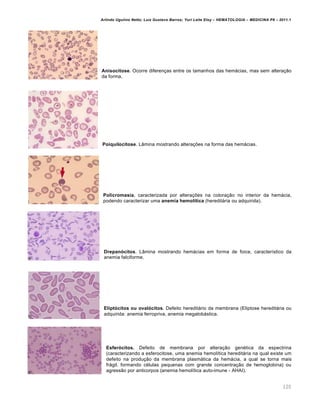 Arlindo Ugulino Netto; Luiz Gustavo Barros; Yuri Leite Eloy – HEMATOLOGIA – MEDICINA P8 – 2011.1
120
Anisocitose. Ocorre diferenças entre os tamanhos das hemácias, mas sem alteração
da forma.
Poiquilocitose. Lâmina mostrando alterações na forma das hemácias.
Policromasia, caracterizada por alterações na coloração no interior da hemácia,
podendo caracterizar uma anemia hemolítica (hereditária ou adquirida).
Drepanócitos. Lâmina mostrando hemácias em forma de foice, característico da
anemia falciforme.
Eliptócitos ou ovalócitos. Defeito hereditário da membrana (Eliptose hereditária ou
adquirida: anemia ferropriva, anemia megalobástica.
Esferócitos. Defeito de membrana por alteração genética da espectrina
(caracterizando a esferocitose, uma anemia hemolítica hereditária na qual existe um
defeito na produção da membrana plasmática da hemácia, a qual se torna mais
frágil, formando células pequenas com grande concentração de hemoglobina) ou
agressão por anticorpos (anemia hemolítica auto-imune - AHAI).
 