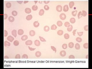 Historia.Hombre 23 años, sin antecedentes mórbidosInicio Abril 2006 (3m evol.)AsteniaFatigabilidadAnorexiaIctericia progresivaOrinas oscuras (no colúricas)