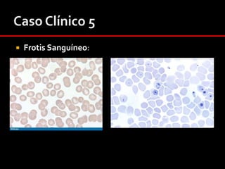 Al ingreso.DestacaHidratado – bien perfundido.Ictericia y palidez de piel y mucosas.Soplo sistólico eyectivo foco pulmonarBazo palpable