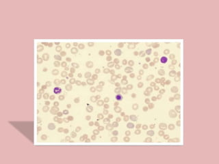 El 25% de los casos presenta
linfadenopatia con ictericia y
cianosis, si coexiste la purpura
trombocitopenica inmunológica...