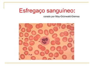 Esfregaço sanguíneo : corado por May-Grünwald-Giemsa  
