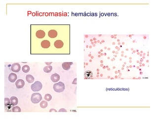 Policromasia :  hemácias jovens. (reticulócitos) 