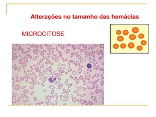 MICROCITOSE Alterações no tamanho das hemácias 