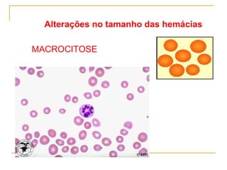 MACROCITOSE Alterações no tamanho das hemácias 