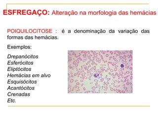 POIQUILOCITOSE :    é a denominação da variação das formas das hemácias.  Exemplos: Drepanócitos Esferócitos   Eliptócitos Hemácias em alvo   Esquisócitos   Acantócitos   Crenadas Etc. ESFREGAÇO:  Alteração na morfologia das hemácias 