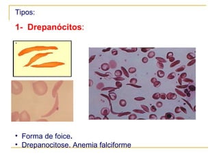 Tipos: 1-  Drepanócitos : . Forma de foice . Drepanocitose. Anemia falciforme 