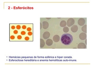 2 - Esferócitos Hemácias pequenas de forma esférica e hiper corada.  Esferocitose hereditária e anemia hemolíticas auto-imune .                              