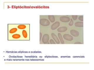    Hemácias elípticas e ovaladas. Ovolacitose hereditária ou eliptocitose, anemias carenciais    e mais raramente nas talassemias 3- Eliptócitos\ovalócitos                              