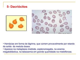 5- Dacriócitos Hemácias em forma de lágrima, que correm provavelmente por retardo da saída  da medula óssea. Aparece na metaplasia mielóide, esplenomegalia, na anemia megaloblástica, na talassemia  em grande quantidade na mielofibrose .                              