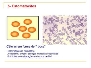 5- Estomatócitos    Células em forma de  “  boca” Estomatocitose hereditária   Alcoolismo, cirrose, doenças hepáticas obstrutivas   Eritrócitos com alterações na bomba de Na/  