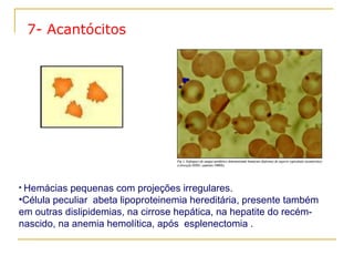   Hemácias pequenas com projeções irregulares.  Célula peculiar  abeta lipoproteinemia hereditária, presente também em outras dislipidemias, na cirrose hepática, na hepatite do recém-nascido, na anemia hemolítica, após  esplenectomia . 7- Acantócitos 