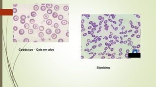 Codócitos – Cels em alvo
Eliptócitos
 