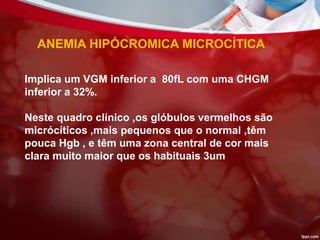 ANEMIA HIPÓCROMICA MICROCÍTICA
Implica um VGM inferior a 80fL com uma CHGM
inferior a 32%.
Neste quadro clínico ,os glóbulos vermelhos são
micrócíticos ,mais pequenos que o normal ,têm
pouca Hgb , e têm uma zona central de cor mais
clara muito maior que os habituais 3um
 