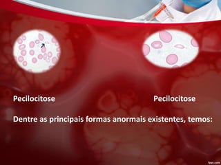 Pecilocitose Pecilocitose
Dentre as principais formas anormais existentes, temos:
 