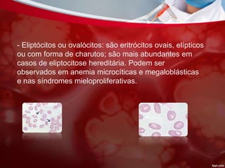 - Eliptócitos ou ovalócitos: são eritrócitos ovais, elípticos
ou com forma de charutos; são mais abundantes em
casos de eliptocitose hereditária. Podem ser
observados em anemia microcíticas e megaloblásticas
e nas síndromes mieloproliferativas.
 