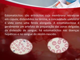 Estomatócitos: são eritrócitos cuja membrana retraiu-se
em cúpula; distendidos na lâmina, a concavidade unilateral
é vista como uma fenda alongada. A estomatocitose é
geralmente um artefato de preparação das zonas delgadas
da distensão de sangue; há estomatócitos nas doenças
hepáticas e no sangue do recém-nascido.
 