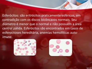 Esferócitos: são eritrócitos praticamente esféricos, em
contradição com os discos bicôncavos normais. Seu
diâmetro é menor que o normal e não possuem a área
central pálida. Esferócitos são encontrados em casos de
esferocitoses hereditária, anemias hemolíticas auto-
imune.
 