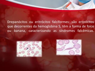Drepanócitos ou eritrócitos falciformes: são eritrócitos
que decorrentes da hemoglobina S, têm a forma de foice
ou banana, caracterizando as síndromes falcêmicas.
 