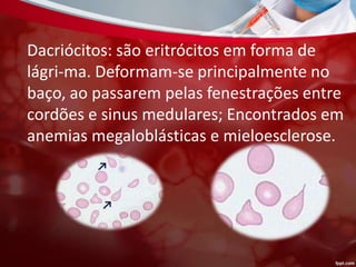 Dacriócitos: são eritrócitos em forma de
lágri-ma. Deformam-se principalmente no
baço, ao passarem pelas fenestrações entre
cordões e sinus medulares; Encontrados em
anemias megaloblásticas e mieloesclerose.
 