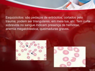 Esquizócitos: são pedaços de eritrócitos, cortados pelo
trauma; podem ser triangulares, em meia lua, etc. Tem curta
sobrevida no sangue.Indicam presença de hemólise,
anemia megaloblástica, queimaduras graves.
 