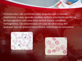 •Células-alvo: são eritrócitos mais delgados que o normal
(leptócitos), e que, quando corados, exibem uma borda periférica
de hemoglobina com uma área central escura, contendo
hemoglobina. São encontradas em caso de obstrutiva, em
qualquer tipo de anemia hipocrômica, sobretudo na talassemia.
 