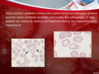 •Equinócitos: também conhecidos como hemácias crenadas, podem
ocorrer como artefatos durante a formação dos esfregaços. In vivo,
podem ser vistos na uremia, no hipotireoidismo, no tratamento com
heparina IV.
 