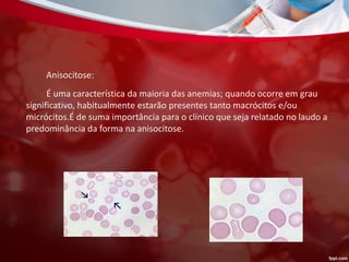 Anisocitose:
É uma característica da maioria das anemias; quando ocorre em grau
significativo, habitualmente estarão presentes tanto macrócitos e/ou
micrócitos.É de suma importância para o clínico que seja relatado no laudo a
predominância da forma na anisocitose.
 
