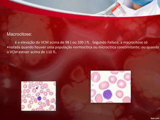 Macrocitose:
é a elevação do VCM acima de 98 ( ou 100 ) fL . Segundo Failace, a macrocitose só
•notada quando houver uma população normocítica ou microcítica concomitante; ou quando
o VCM estiver acima de 110 fL.
 