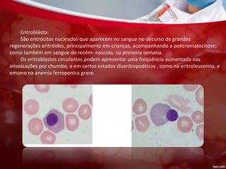Eritroblásto:
São eritrócitos nucleados que aparecem no sangue no decurso de grandes
regenerações eritróides, principalmente em crianças, acompanhando a policromatocitose;
como também em sangue do recém- nascido, na primeira semana.
Os eritroblastos circulantes podem apresentar uma freqüência aumentada nas
intoxicações por chumbo, e em certos estados diseritropoéticos , como na eritroleucemia, e
emsmo na anemia ferropenica grave.
 